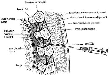 Gambar 4. Ligamen costotransversa superior terletak diantara processus transversus 