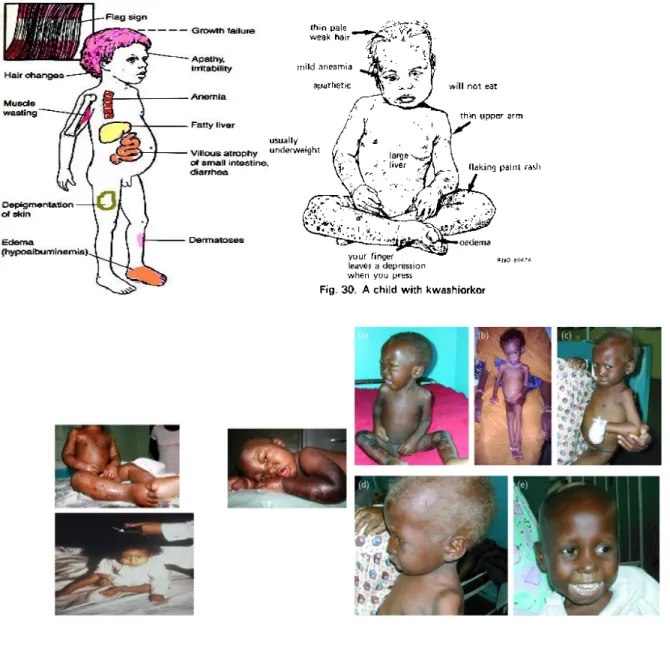 Gambar 3. Manifestasi klinis kwashiorkor