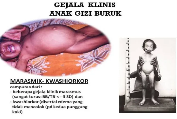 Gambar 5. Manifestasi klinis Marasmus-Kwashiorkor
