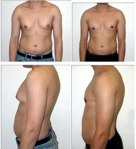 Gambar 6. Sebelum dan setelah operasi Liposuctio-assisted mastectomy 