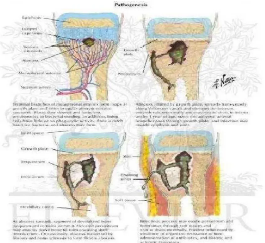 Gambar 2.2 Proses osteomielitis 9