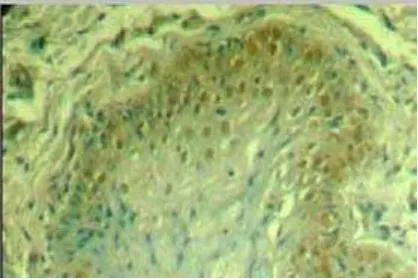 Gambar 3: Gambaran histopatologi OHL pada pasien HIV . 23