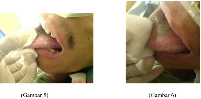 Gambar : (5) Bercak putih pada lateral lidah pasien. (6) bercak putih kehijauan pada 