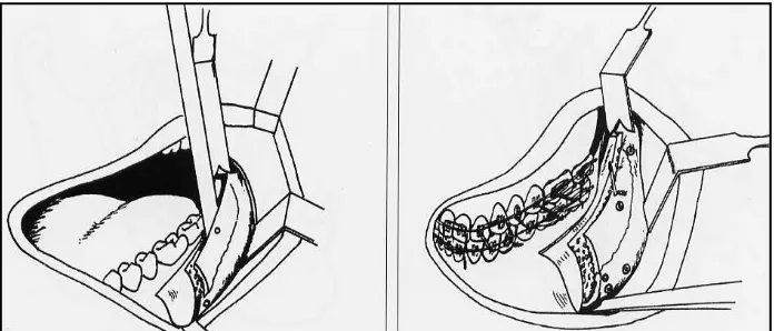 Gambar 16 :  Pemisahan  mandibula. (Reyneke JP . Essential of orthognathic surgeryChicago: Quitessence Publishing Co, 2003: 257)