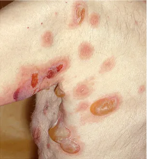 Gambar 8: Lesi utama pemfigus vulgaris bula yang lembek.