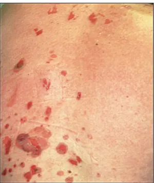 Gambar 9:  Pemphigus vulgaris. Erosions and flaccid bullae pada kulit normal.