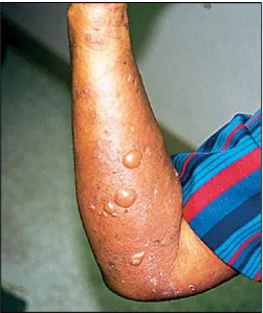 Gambar 3:  Pemfigoid Bulosa. Bula tegang diatas kulit yang eritema.