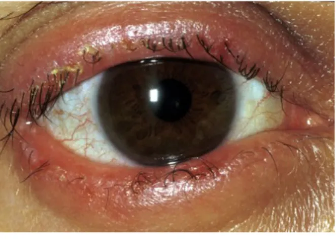 Gambar 3 : Radang pada kelopak mata (blefaritis)