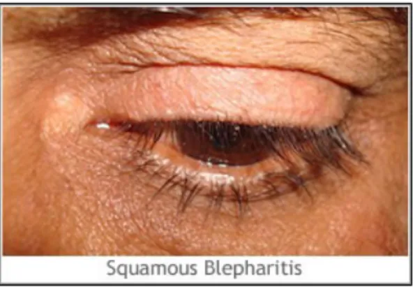 Gambar 7 : Squamous Blepharitis