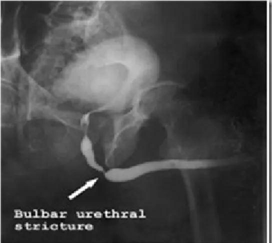 GAMBAR 4. Retrograde urethrogram menunjukkan striktur uretra bulbar iv. Instrumentasi