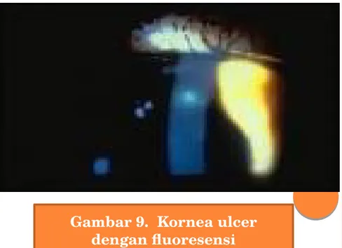 Gambar 9.  Kornea ulcer  dengan fluoresensi