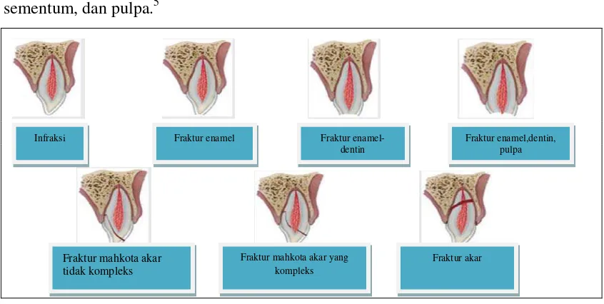 Gambar 1. Kerusakan pada Jaringan Keras Gigi dan Pulpa16