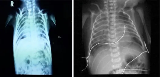 Gambar 1.2. Foto Rontgen thoraks anak saat terdiagnosis BPD (usia 3 bulan) (kiri);  