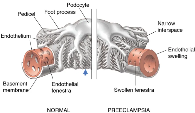 Gambar 3. Endoteliosis kapiler glomerulus 