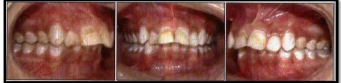 Gambar 2. Maloklusi Klas II Angle 22