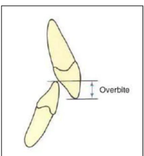 Gambar 8. Overbite 22