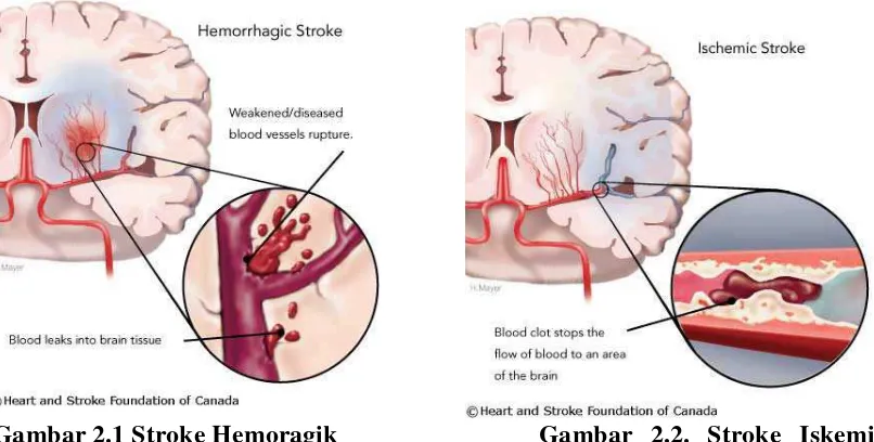 Gambar 2.1 Stroke Hemoragik  