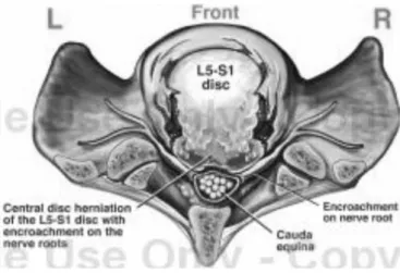 Gambar 2.3 Proses Hernia Disk Pada L5/S1 (Tampak Atas) 