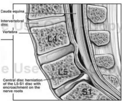 Gambar 2.4 Proses Hernia Disk Pada L5/S1 (Tampak Samping) 
