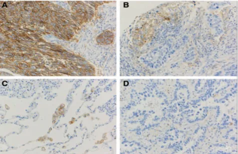 Gambar  2.1.  Programmed  death  receptor-1  dengan  ligand  (PDL-1)  immunostaining  dilakukan  menggunakan  klon  E1LN3N  anti-PD-L1  dari  Cell  Signaling  Technology  (Boston)  dengan  teknik  deteksi  standar