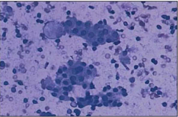 Gambar 2.9.  Tiroiditis  Limpocitik. Dua Kelompok Dari Sel Folikuler Jinak  Tampak Pada Latar Belakang Limposit ( Mary JW, 2003)