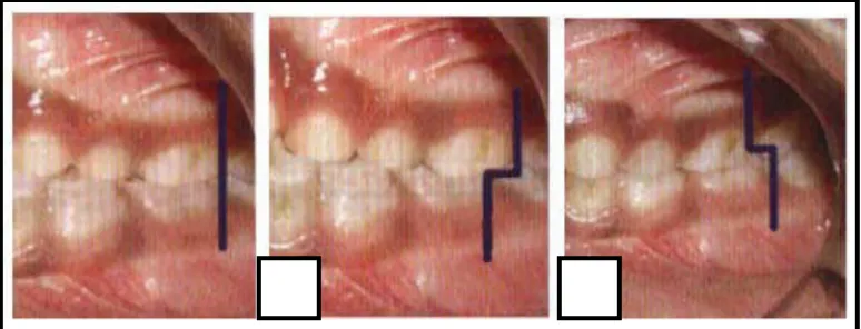 Gambar 2. Hubungan molar pada periode gigi desidui a. Flush terminal plane,  b.Mesial step, c