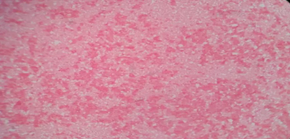 Gambar 2. Hasil pewarnaan gram pada pembesaran 1000x terlihat   bakteri  berbentuk   kokobasilus berwarna pink