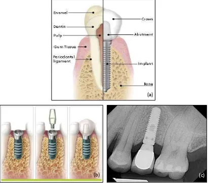 Gambar 6. Single-tooth implant (a) dan (b) Ilustrasi.43-4 (c) Radiografi.45   