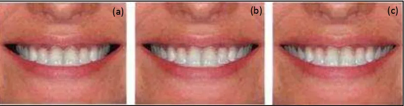 Gambar 7. Buccal corridor (a) Maksimum. (b) Ideal. (c) Minimum.46  