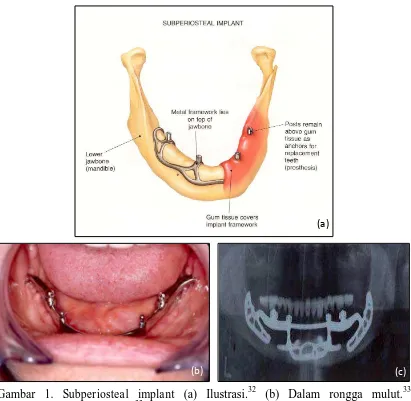 Gambar 1. Subperiosteal implant (a) Ilustrasi.32 (b) Dalam rongga mulut.33   (c) Radiografi.33 