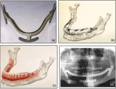 Gambar 3. Ramus implant (a) Bentuk.36 (b) dan (c) Ilustrasi.36 (d) Radiografi.35  