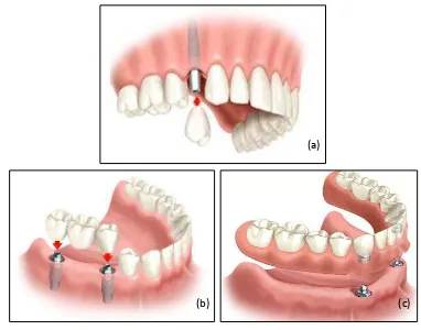 Gambar 5.  Root implant (a) Mengganti kehilangan satu gigi, single-tooth implant.40 (b) Mengganti kehilangan gigi sebagian, implant-supported bridge.41  (c) Mengganti kehilangan seluruh gigi, implant-supported overdenture.42 