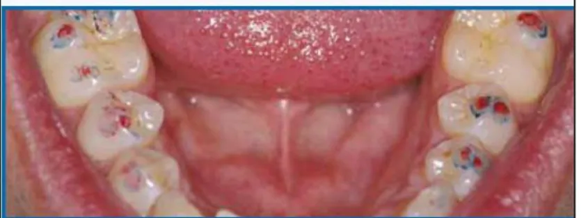 Gambar 15. Tanda pada Gigi yang Dihasilkan Setelah  Menggunakan Kertas Artikulasi 38