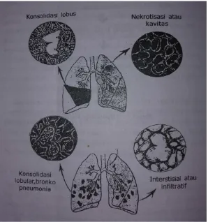 Gambar 2.1 Bentuk-bentuk Pneumonia 
