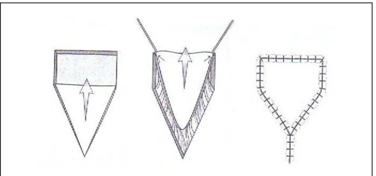 Gambar 4 : Advancement flap with Burow's triangle (Watkinson JC,Gaze MN, Wilson JA . Stell & maran’s head and neck surgery