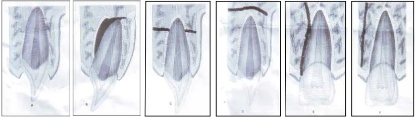 Gambar 3.  A. Comminution of alveolar socket, B. Fraktur pada fasial dan lingual dinding soket alveolar, C
