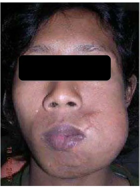 Gambar 1. Gambaran ekstra oral berupa pembengkakan pada regio bukal kiri mandibula dan menyebabkan wajah asimetris