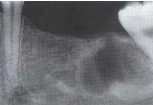 Gambar 3. Gambaran radiolusen awal cemento ossifying fibroma pada daerah edentulous prosesus alveolaris (White SC, Pharoah MJ