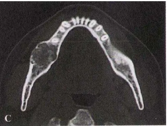 Gambar 5. CT scan foto menunjukkan lesi juga ekspansi kearah bukal dan lingual dengan bentuk tulang trabekular terlihat jelas dalam lesi, korteks bukal mengalami erosi dan menjadi sangat tipis