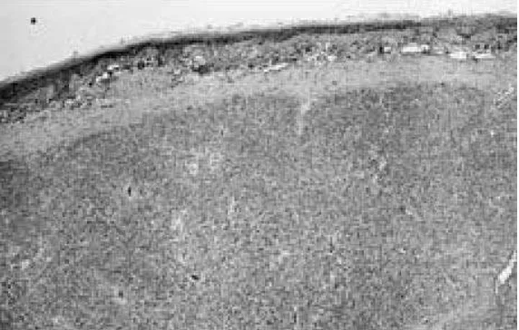 Gambar 7. Gambaran mikroskopis menunjukkan adanya batas perifer dan kapsul pada cemento ossifying fibroma