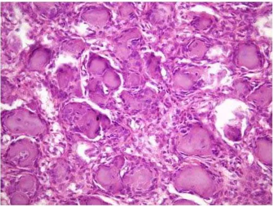 Gambar 8. Sel yang mengandung banyak osteoblast pada permukaannya  dan struktur seperti badanpathological findings psammamo