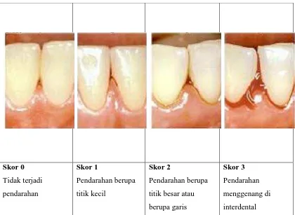 Gambar 2.  Indeks perdarahan papilla dimodifikasi menurut Saxen dan Muhlemen (Reteitschak dkk., Colour Atlas of Periodontology, 1985; 30)  