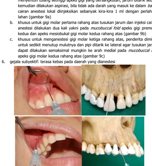 Gambar 9a.  Field Block  dengan teknik  paraperiosteal injection  pada gigi insisif sentral  rahang atas kanan ( atas ) dan gigi premolar pertama  rahang atas kanan ( bawah ); jarum  ditusukkan pada cekungan terdalam pada  mucolabial fold  atau  mucobuccal