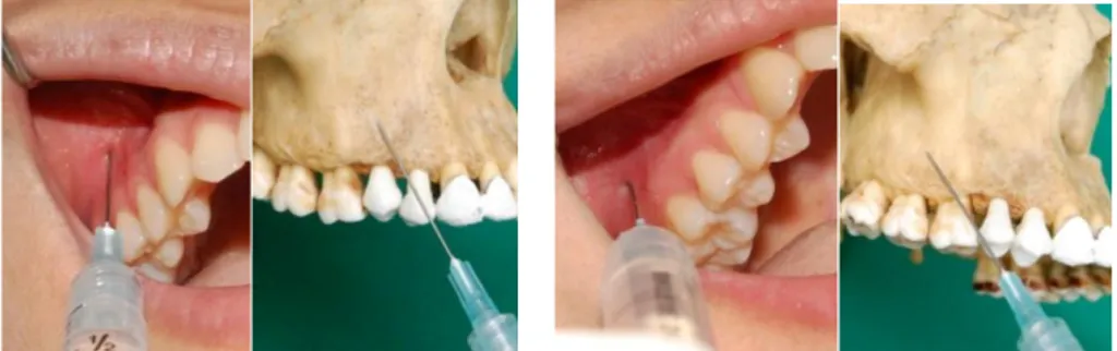 Gambar 9b.  Field block  untuk menganestesi gigi molar pertama rahang atas kanan;  injeksi dilakukan dua kali yaitu pada  mucobuccal fold  apeks gigi premolar kedua rahang  atas  kanan  (kiri)  dan  mucobuccal  fold   apeks  gigi  molar  kedua  rahang  atas  kanan  ( kanan );  