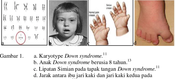 Gambar 1.  a. Karyotype Down syndrome.11  b. Anak Down syndrome berusia 8 tahun.13  