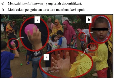 Gambar 3. Kriteria penderita Down syndrome. a) Lipatan Simian  b) Mulut agak terbuka c) Jari yang pendek  