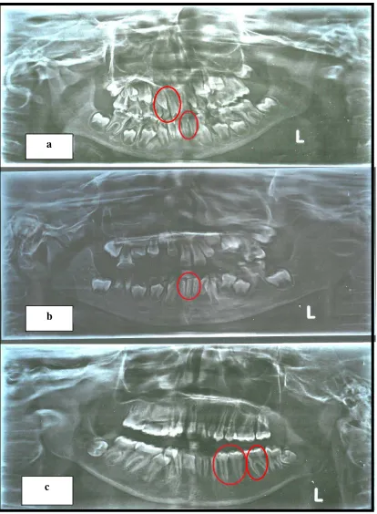 Gambar 4. Radiograf panoramik yang menunjukkan dental anomaly    a) Hipodonsia (gigi 12,32) b) Mikrodonsia (gigi 31,32,41)  c) Taurodonsia (gigi 34,35,36) 