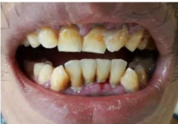 Gambar  2.  Gingivitis  pada  pasien  skizofrenia,  tampak  gingiva  gigi  anterior  bawah  hiperemia,  membengkak,  dan  udematus