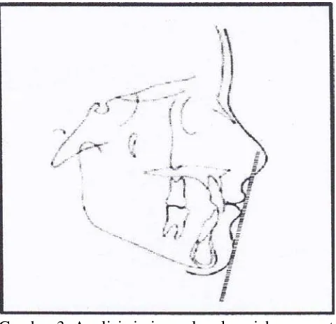 Gambar 3. Analisis jaringan lunak wajah menurut 