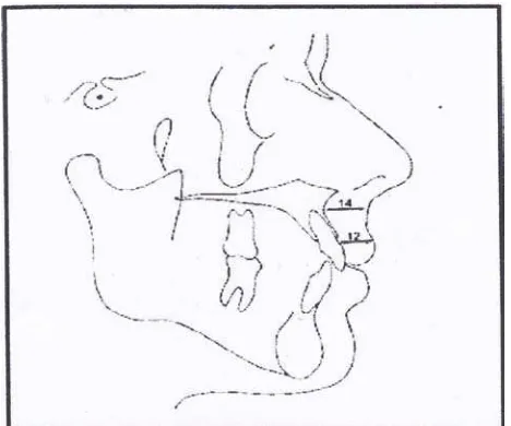 Gambar 4. Tebal bibir atas dan strain bibir atas.4